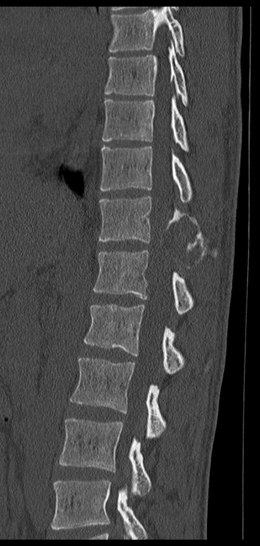 Aneurysmal bone cyst T11 (Radiopaedia 29294-29721 Sagittal bone window 36).jpg