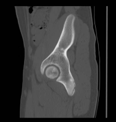 Aneurysmal bone cyst of ischium (Radiopaedia 25957-26094 Sagittal bone window 22).png