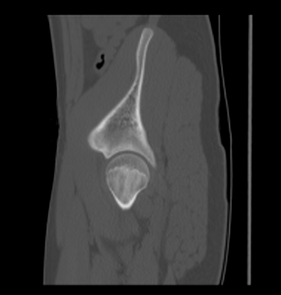 Aneurysmal bone cyst of ischium (Radiopaedia 25957-26094 Sagittal bone window 59).png