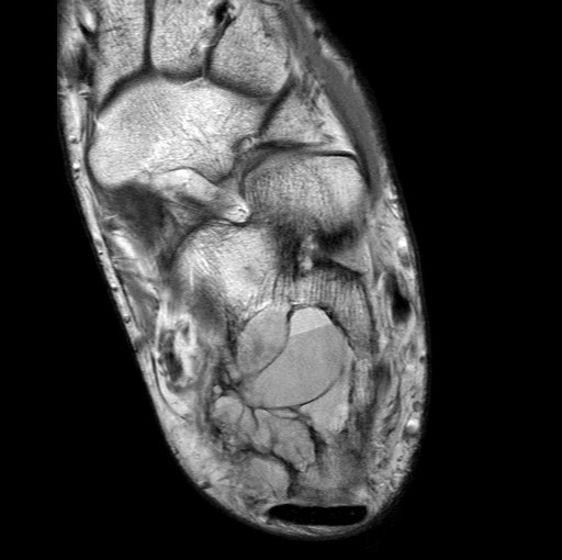 File:Aneurysmal bone cyst of the calcaneus (Radiopaedia 60669-68420 Axial PD 13).jpg