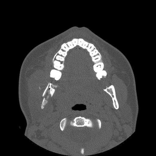 Aneurysmal bone cyst of the mandible (Radiopaedia 43280-46823 Axial bone window 78).jpg