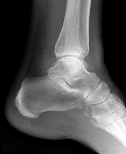 File:Ankle fracture - Weber A (Radiopaedia 12267-12567 Lateral 1).jpeg