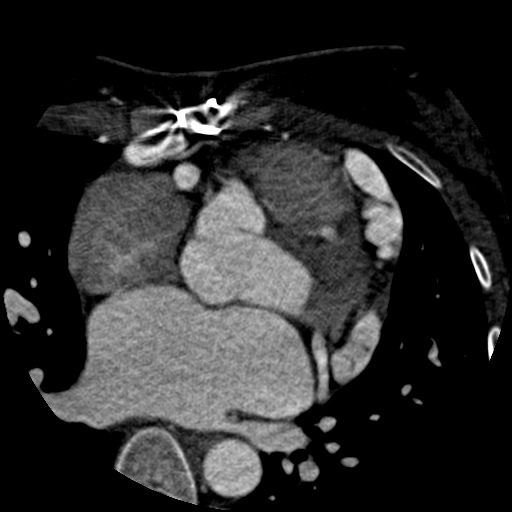 Anomalous left coronary artery from the pulmonary artery (ALCAPA) (Radiopaedia 40884-43586 A 29).jpg