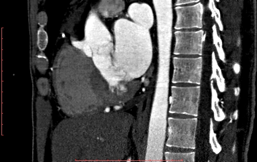 Anomalous left coronary artery from the pulmonary artery (ALCAPA) (Radiopaedia 70148-80181 C 119).jpg