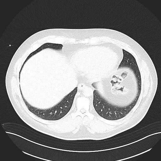 File:Anomalous origin of the left coronary artery with malignant course (Radiopaedia 77842-90126 Axial lung window 27).jpeg