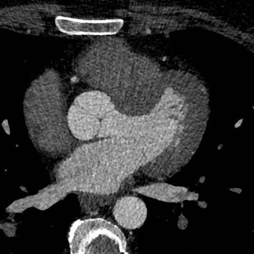 File:Anomalous origin of the left coronary artery with malignant course (Radiopaedia 77842-90126 C 112).jpeg