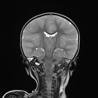File:Anoxic brain injury (Radiopaedia 79165-92139 Coronal T2 16).jpg