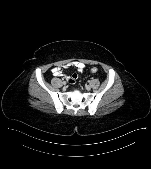 Anterior abdominal wall CSF pseudocyst (CSFoma) (Radiopaedia 79453-92571 A 70).jpg