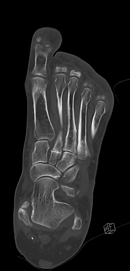 Anterior calcaneal process fracture (Radiopaedia 63353-71943 Coronal bone window 23).jpg