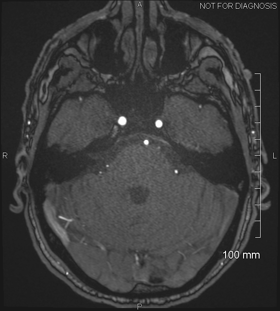 Anterior cerebral artery aneurysm (Radiopaedia 80683-94127 Axial MRA 63).jpg