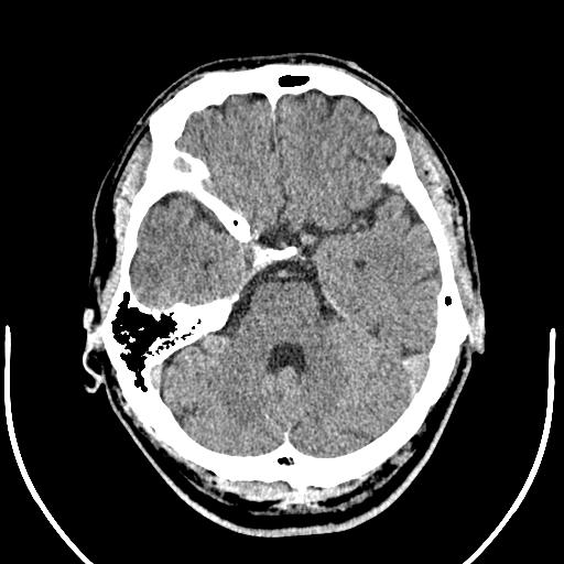 Anterior choroidal artery infarct (Radiopaedia 55106-61480 Axial non-contrast 15).jpg