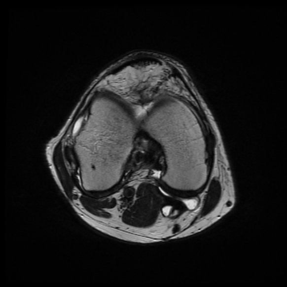 File:Anterior cruciate ligament graft tear and bucket-handle tear of medial meniscus (Radiopaedia 75867-87254 Axial T2 13).jpg