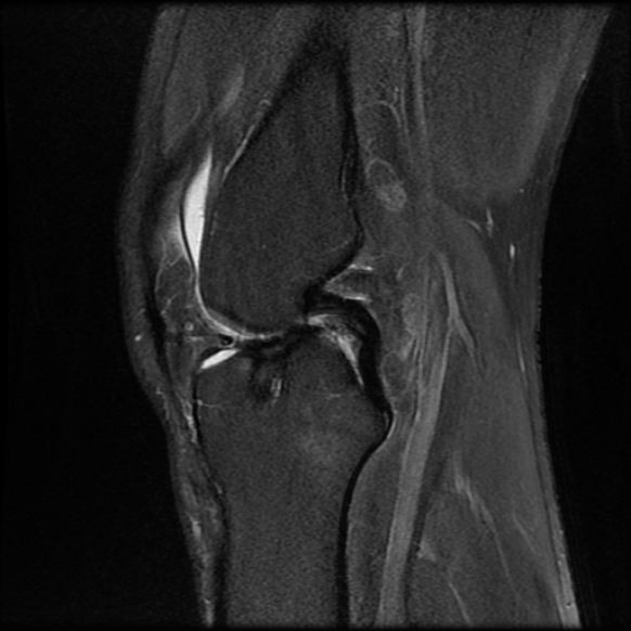 File:Anterior cruciate ligament graft tear and bucket-handle tear of medial meniscus (Radiopaedia 75867-87254 Sagittal PD fat sat 13).jpg