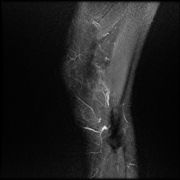 File:Anterior cruciate ligament graft tear and bucket-handle tear of medial meniscus (Radiopaedia 75867-87254 Sagittal PD fat sat 27).jpg