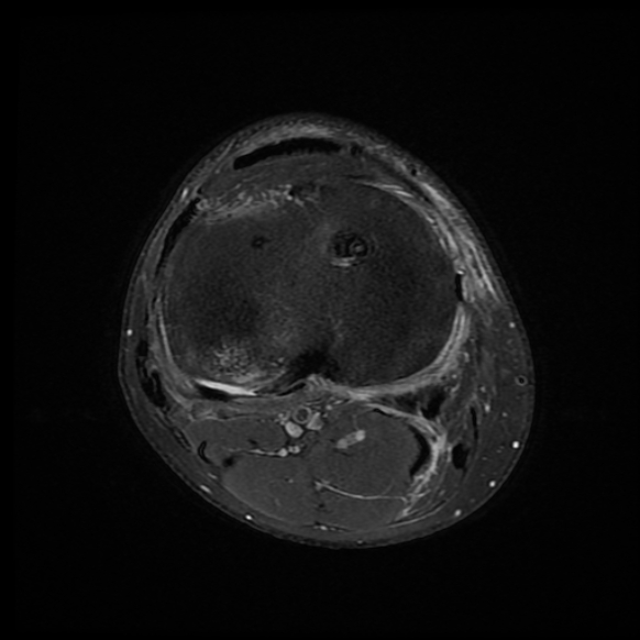 File:Anterior cruciate ligament graft tear and bucket-handle tear of medial meniscus (Radiopaedia 75867-87255 Axial PD fat sat 5).jpg