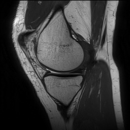 Anterior cruciate ligament rupture and posteromedial corner injury (Radiopaedia 67338-76723 Sagittal PD 55).jpg