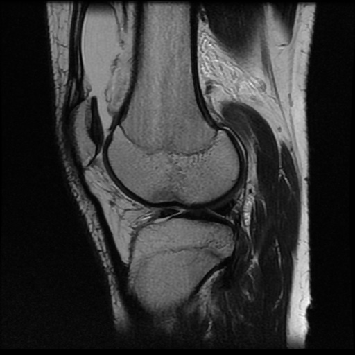 File:Anterior cruciate ligament tear (Radiopaedia 61500-69462 Sagittal T2 14).jpg