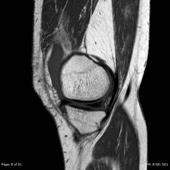 File:Anterior cruciate ligament tear (Radiopaedia 70783-80964 Sagittal T1 8).jpg