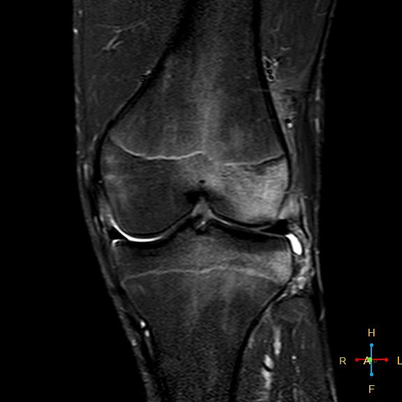 File:Anterior cruciate ligament tear - complete (Radiopaedia 24907-25170 Coronal STIR 11).jpg