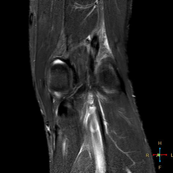 File:Anterior cruciate ligament tear - complete (Radiopaedia 24907-25170 Coronal STIR 17).jpg