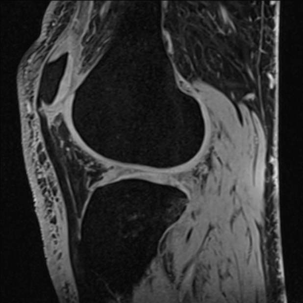 Anterior cruciate ligament tear - ramp lesion (Radiopaedia 71883-82322 Sagittal T1 vibe 49).jpg