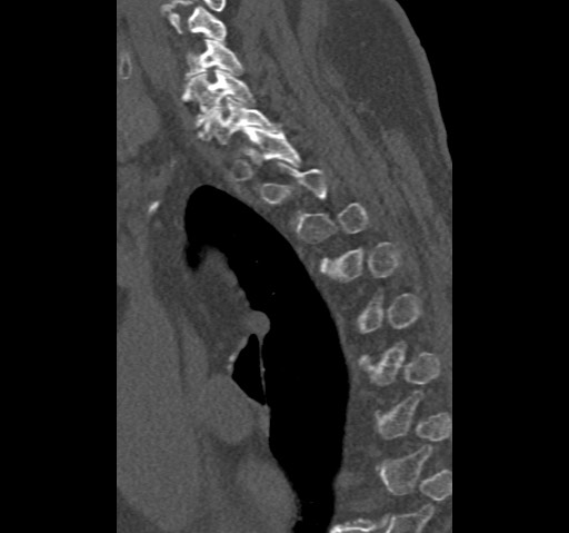 Anterior glenohumeral dislocation with Hill-Sachs lesion (Radiopaedia 62877-71249 Sagittal bone window 78).jpg
