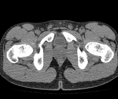 Anterior inferior iliac spine avulsion fracture (Radiopaedia 81312-94999 Axial non-contrast 62).jpg