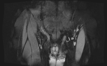 Anterior inferior iliac spine avulsion fracture (Radiopaedia 81312-95000 G 104).jpg