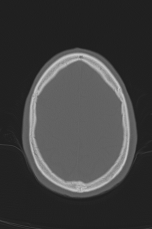 Anterior nasal spine fracture (Radiopaedia 46138-50494 Axial bone window 15).png