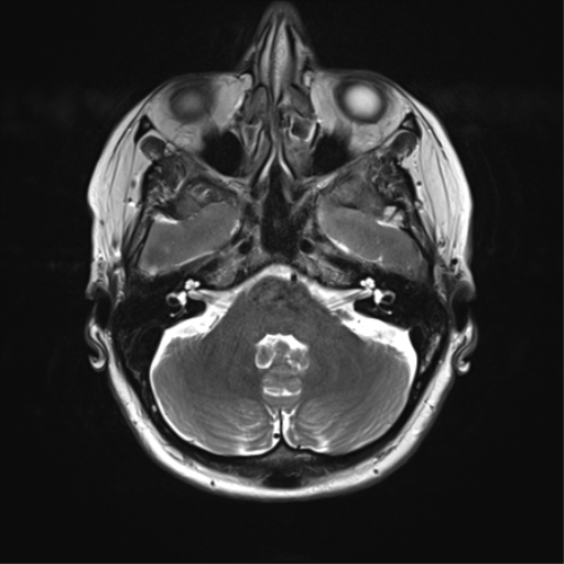 File:Anterior temporal lobe perivascular space (Radiopaedia 40946-43650 Axial T2 9).png
