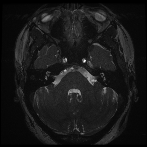 Anterior temporal lobe perivascular space (Radiopaedia 68481-78041 E 9).png