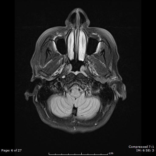 File:Anterior temporal lobe perivascular space (Radiopaedia 88283-104914 Axial FLAIR 6).jpg