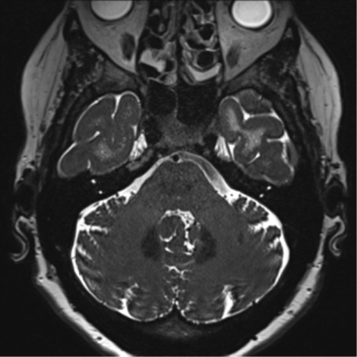File:Anterior temporal pole cysts (Radiopaedia 46629-51102 Axial T2 38).png