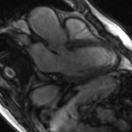 File:Anteroseptal hypokinesia after myocardial infarction (Radiopaedia 15978-15633 3 chamber view SSFE 15).jpg