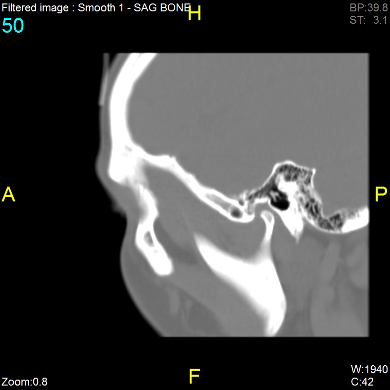 Antrochoanal polyp (Radiopaedia 65101-74094 Sagittal bone window 50).jpg
