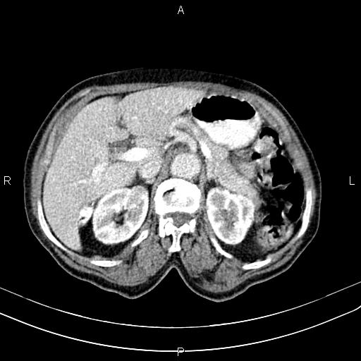 File:Aortic aneurysm and Lemmel syndrome (Radiopaedia 86499-102554 A 27).jpg