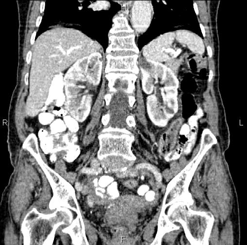 Aortic aneurysm and Lemmel syndrome (Radiopaedia 86499-102554 C 40).jpg