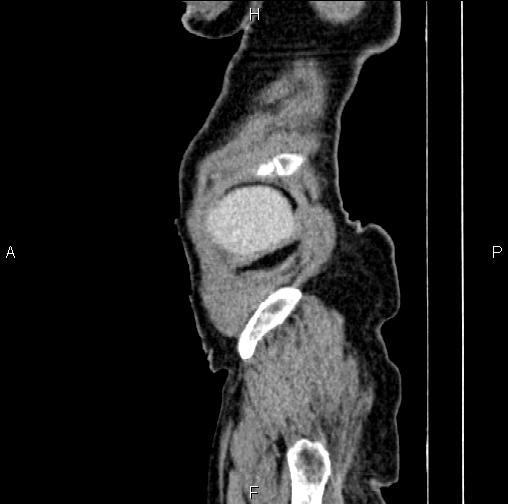 Aortic aneurysm and Lemmel syndrome (Radiopaedia 86499-102554 D 1).jpg
