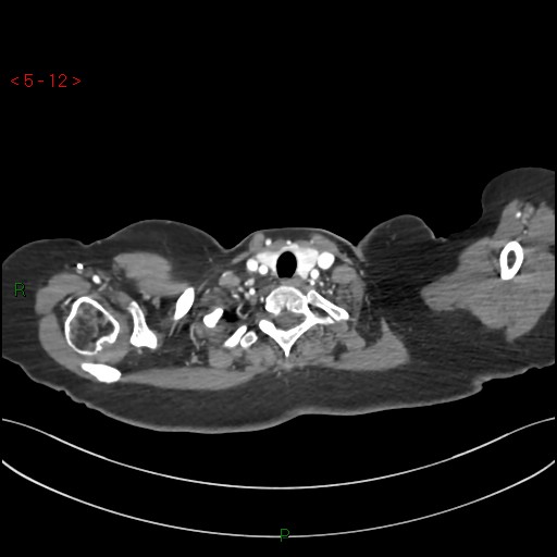 Aortic arch origin of left vertebral artery (Radiopaedia 51520-57286 A 11).jpg