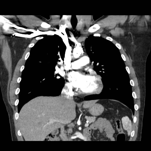 File:Aortic arch stent (Radiopaedia 30030-30595 F 11).jpg