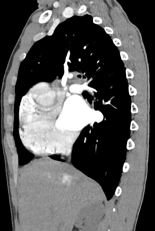 Aortic coarctation with aneurysm (Radiopaedia 74818-85828 B 60).jpg
