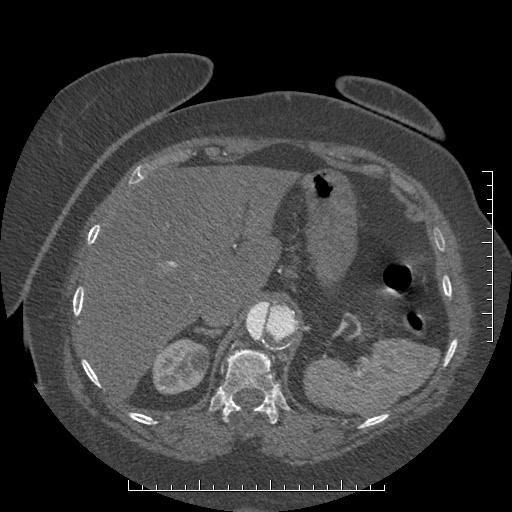Aortic dissection- Stanford A (Radiopaedia 35729-37268 B 34).jpg