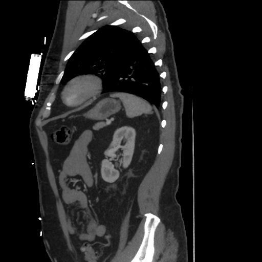 File:Aortic dissection- Stanford A (Radiopaedia 37759-39664 Sagittal C+ delayed 37).png