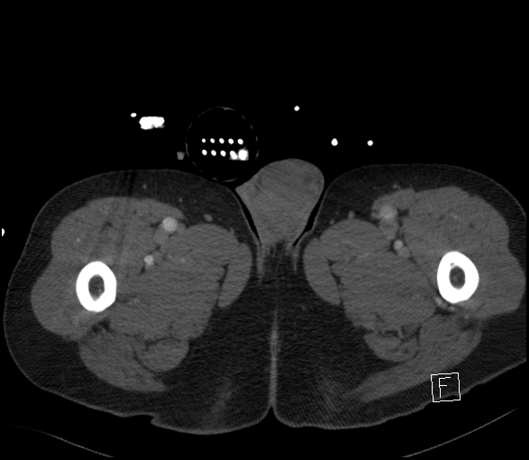 Aortic dissection (CTPA) (Radiopaedia 75506-86750 E 186).jpg