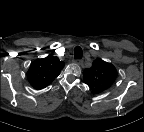 Aortic dissection (CTPA) (Radiopaedia 75506-86751 Axial C+ CTPA 19).jpg