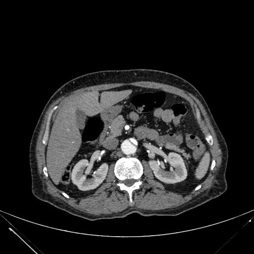 Aortic dissection (Radiopaedia 27466-27665 C+ arterial phase 338).jpg