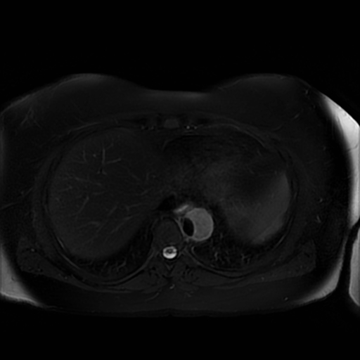 File:Aortic dissection (Radiopaedia 57969-64956 Axial T2 fat sat 11).jpg