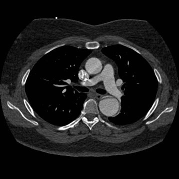 Aortic dissection (Radiopaedia 57969-64959 A 132).jpg