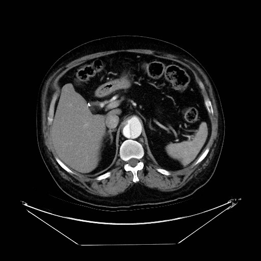 Aortic dissection (Radiopaedia 62562-71000 A 51).jpg