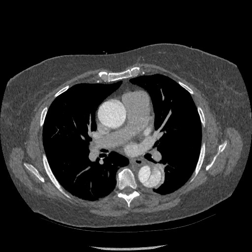 Aortic dissection - Stanford type B (Radiopaedia 88281-104910 A 40).jpg